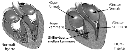 bild på HCm hjärta